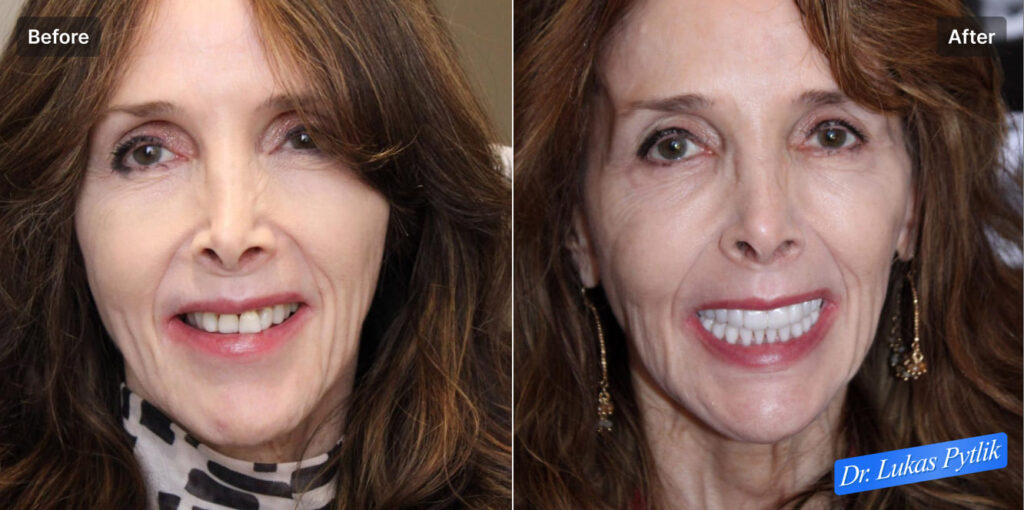 Portrait smile view showing treatment transformation from pre-treatment condition to completed rehabilitation.