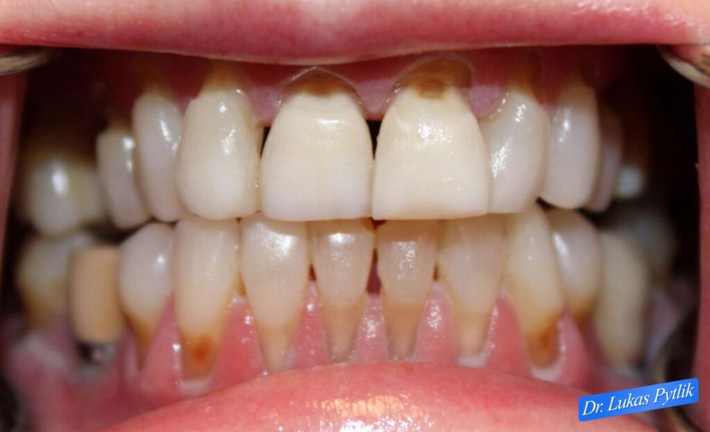 Before, Retracted Teeth Together