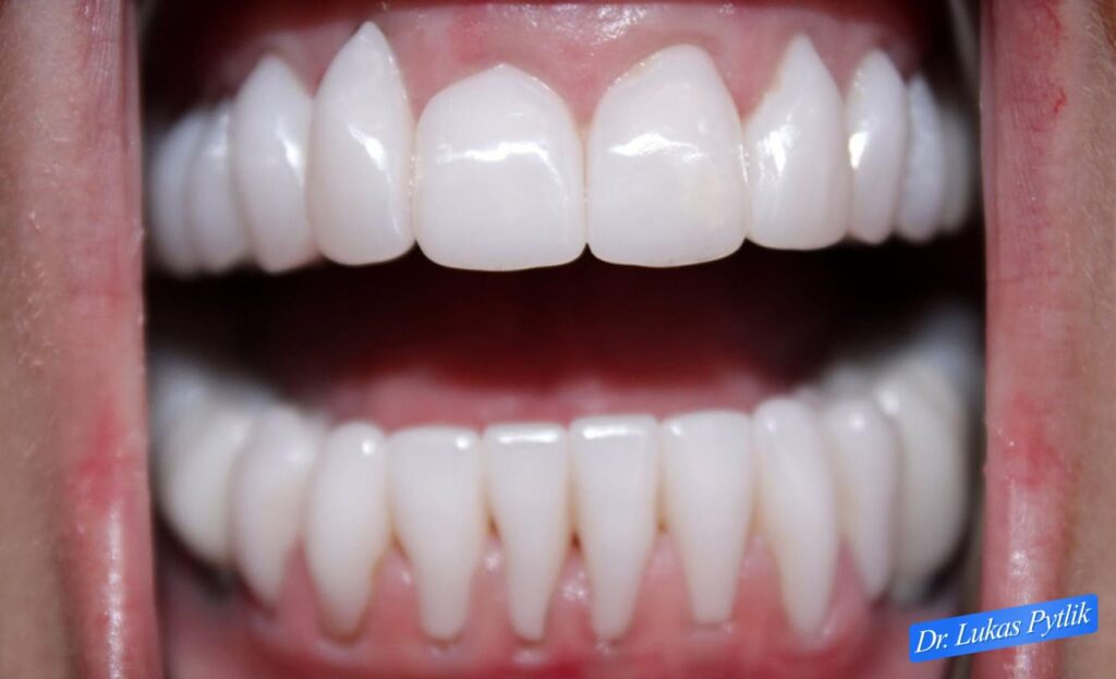 After, Retracted Teeth Together - Wide View